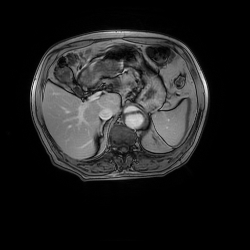 File:Aortic dissection - Stanford A - DeBakey I (Radiopaedia 23469-23551 Axial MRA 39).jpg