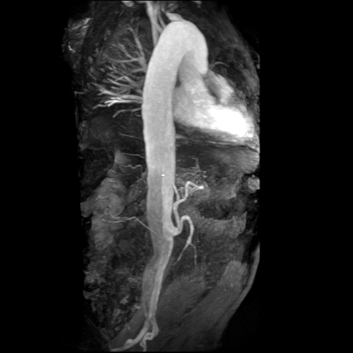 File:Aortic dissection - Stanford A - DeBakey I (Radiopaedia 23469-23551 MRA 5).jpg