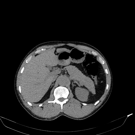 File:Aortic dissection - Stanford type A (Radiopaedia 83418-98500 Axial non-contrast 46).jpg