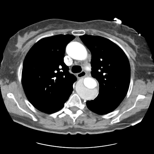 File:Aortic dissection - Stanford type B (Radiopaedia 50171-55512 A 17).png