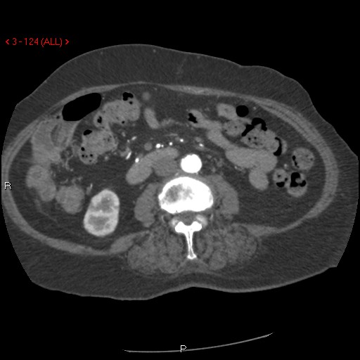 File:Aortic intramural hematoma (Radiopaedia 27746-28001 A 124).jpg