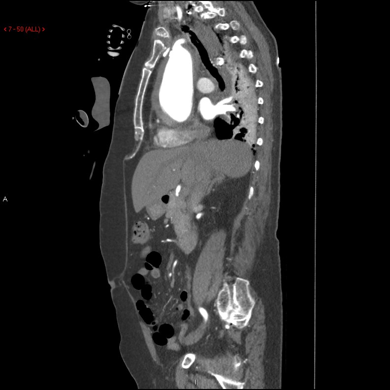 Aortic intramural hematoma (Radiopaedia 27746-28001 C 19).jpg