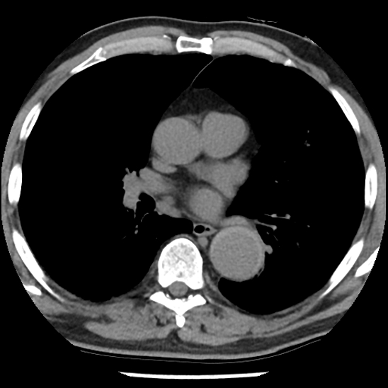 Aortic intramural hematoma (type B) (Radiopaedia 79323-92387 Axial non-contrast 27).jpg