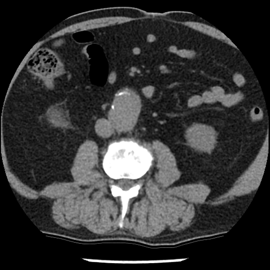 Aortic intramural hematoma (type B) (Radiopaedia 79323-92387 Axial non-contrast 76).jpg
