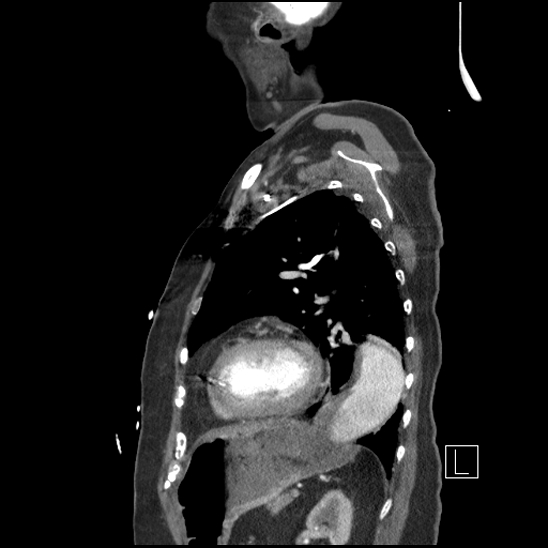Aortic intramural hematoma with dissection and intramural blood pool (Radiopaedia 77373-89491 D 63).jpg