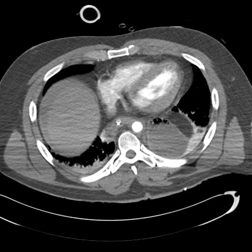 Aortic transection, diaphragmatic rupture and hemoperitoneum in a complex multitrauma patient (Radiopaedia 31701-32622 A 59).jpg
