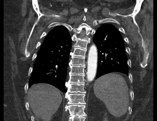 Aortoesophageal fistula with endovascular repair (Radiopaedia 73781-84592 Coronal C+ CTPA 102).jpg