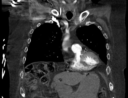 Aortoesophageal fistula with endovascular repair (Radiopaedia 73781-84592 Coronal C+ CTPA 33).jpg
