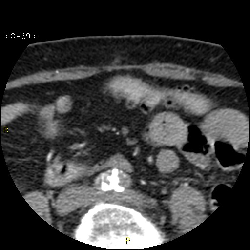Aortoiliac occlusive disease (Radiopaedia 16828-16548 A 69).jpg