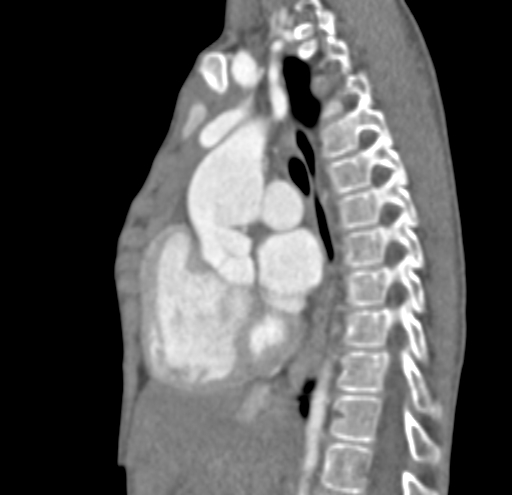 File:Aortopulmonary window, interrupted aortic arch and large PDA giving the descending aorta (Radiopaedia 35573-37074 C 18).jpg
