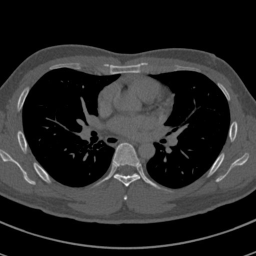 Apical lung mass mimic - neurogenic tumor (Radiopaedia 59918-67521 Axial bone window 41).jpg