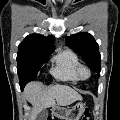 Apical lung mass mimic - neurogenic tumor (Radiopaedia 59918-67521 B 41).jpg