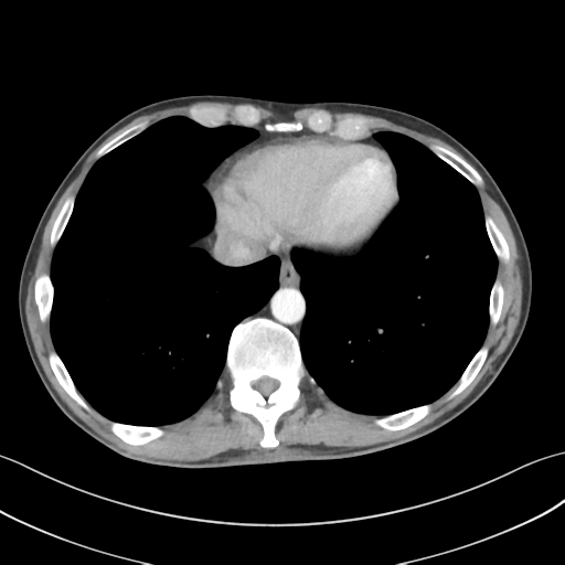 File:Apical pleural calcification (Radiopaedia 46141-50499 Axial C+ delayed 54).png