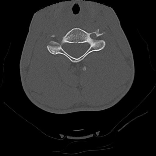 Apical pneumothorax on cervical spine CT (Radiopaedia 45343-49368 Axial bone window 52).jpg
