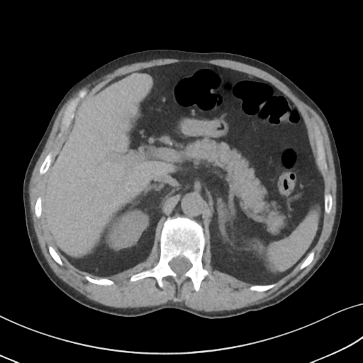 Apical pulmonary metastasis (Radiopaedia 46338-50754 B 64).png