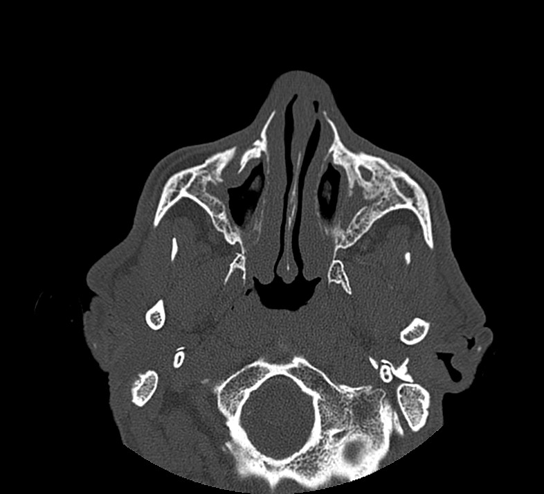 Aplastic maxillary sinuses (Radiopaedia 60030-67561 Axial non-contrast 26).jpg