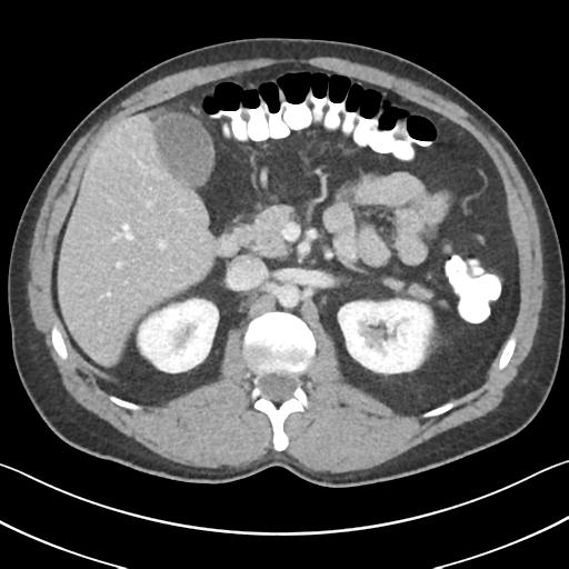 File:Appendicitis with cecal bar sign (Radiopaedia 31878-32830 B 29).jpg