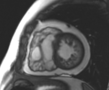 File:Arrhythmogenic right ventricular cardiomyopathy (Radiopaedia 69431-79307 Short axis cine 93).jpg