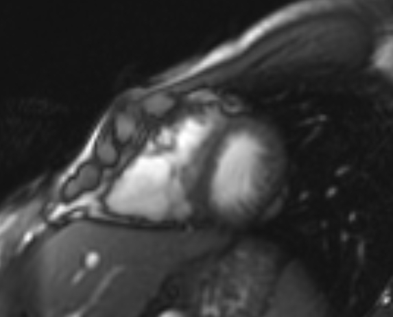 Arrhythmogenic right ventricular cardiomyopathy (Radiopaedia 69564-79464 short axis cine 90).jpg