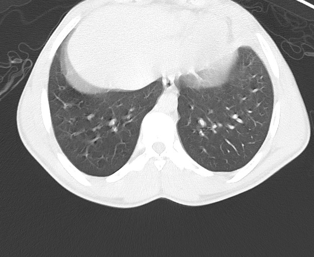 Arrow injury to the chest (Radiopaedia 75223-86321 Axial lung window 73).jpg