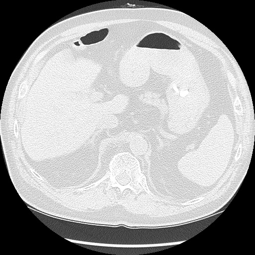 Asbestos-related pleural disease (Radiopaedia 74366-85250 Axial lung window 112).jpg
