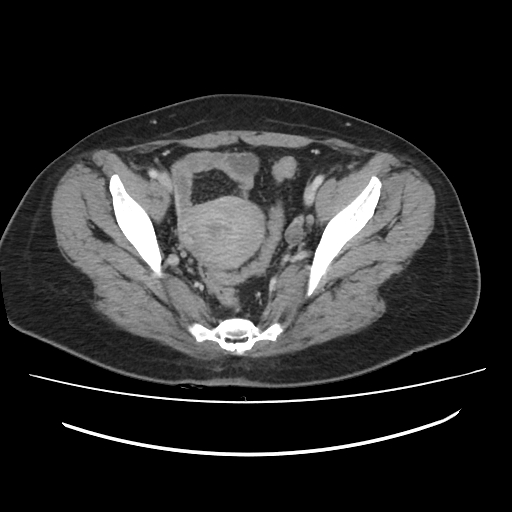 Ascending retrocecal appendicitis with liver abscesses (Radiopaedia 60066-67615 B 77).jpg