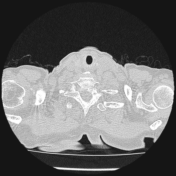 Aspergilloma (Radiopaedia 24458-24763 Axial lung window 1).jpg