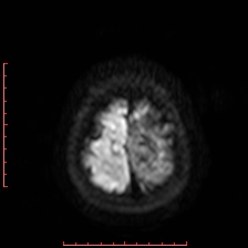 File:Astroblastoma (Radiopaedia 74287-85162 Axial DWI 104).jpg