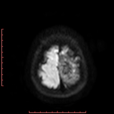 Astroblastoma (Radiopaedia 74287-85162 Axial DWI 105).jpg