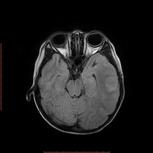 File:Astroblastoma (Radiopaedia 74287-85162 Axial FLAIR 7).jpg