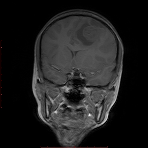 File:Astroblastoma (Radiopaedia 74287-85162 Coronal T1 8).jpg
