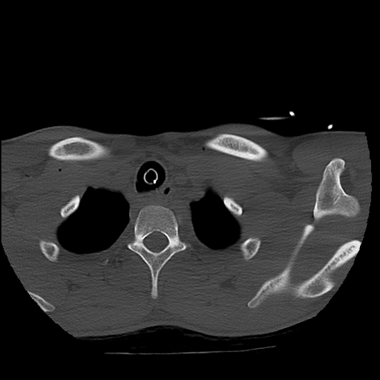 File:Atlanto-occipital dissociation (Traynelis type 1), C2 teardrop fracture, C6-7 facet joint dislocation (Radiopaedia 87655-104061 Axial bone window 95).jpg