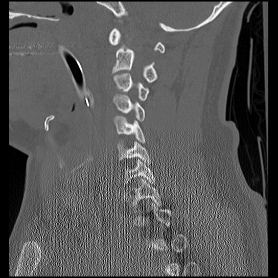 Atlanto-occipital dissociation injury (Radiopaedia 29274-29698 Sagittal bone window 24).png