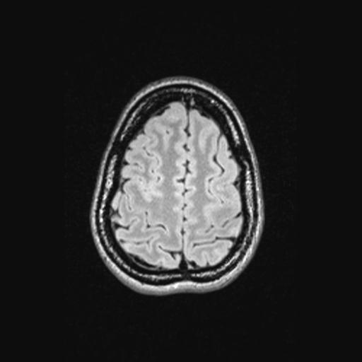 Atretic encephalocoele with inferior vermis hypoplasia (Radiopaedia 30443-31108 Axial 130).jpg