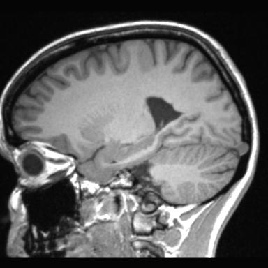 Atretic encephalocoele with inferior vermis hypoplasia (Radiopaedia 30443-31108 Sagittal T1 86).jpg