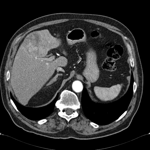 Atypical hepatocellular carcinoma (Radiopaedia 41744-44698 A 24).jpg