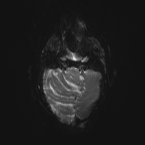 Atypical medulloblastoma (Radiopaedia 34903-36371 Axial DWI 5).jpg