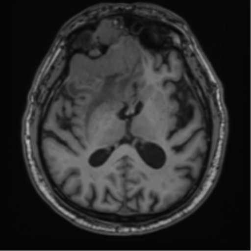 File:Atypical meningioma (WHO grade II) with brain invasion (Radiopaedia 57767-64729 Axial T1 26).png