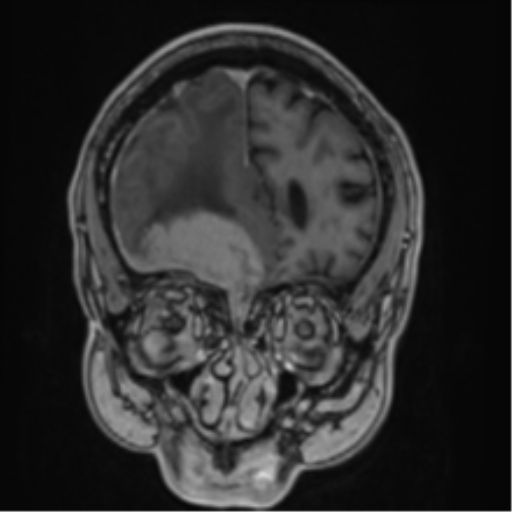Atypical meningioma (WHO grade II) with brain invasion (Radiopaedia 57767-64729 Coronal T1 C+ 17).png