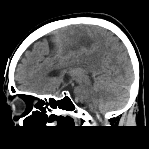 Atypical meningioma (WHO grade II) with osseous invasion (Radiopaedia 53654-59715 C 27).png