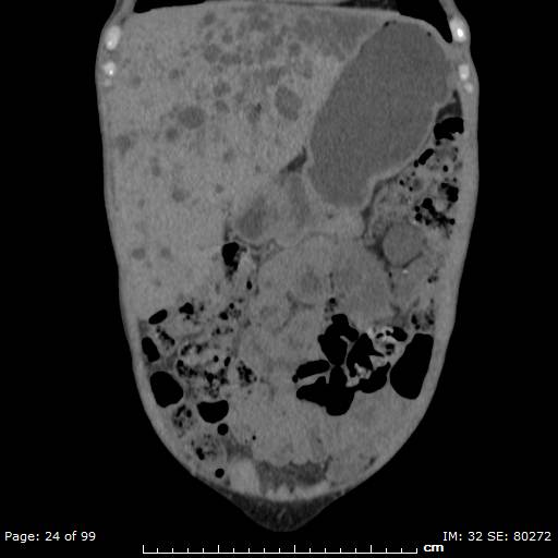 File:Autosomal dominant polycystic kidney disease (Radiopaedia 44122-47684 Coronal 21).jpg