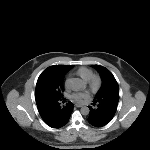 Autosomal dominant polycystic kidney disease (Radiopaedia 50259-55612 Axial non-contrast 2).jpg