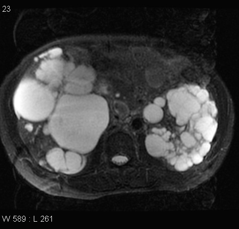 File:Autosomal dominant polycystic kidney disease (Radiopaedia 5202-6969 Axial T2 fat sat 9).jpg