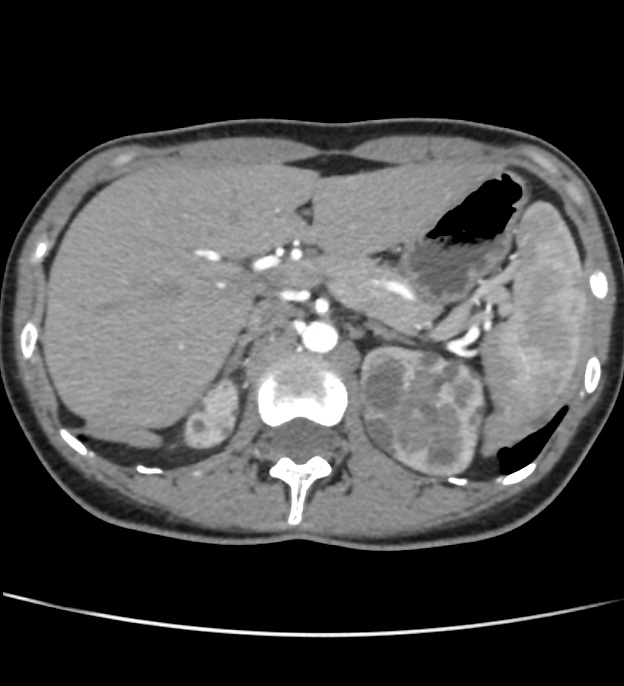 Autosomal dominant polycystic kidney disease - early onset (Radiopaedia 40734-43387 B 7).jpg