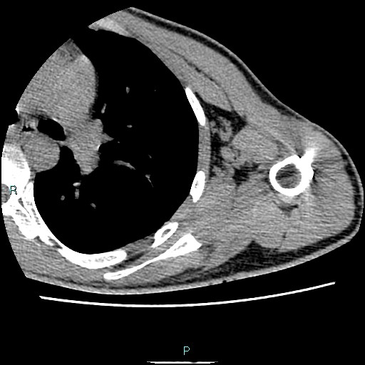 File:Avascular necrosis after fracture dislocations of the proximal humerus (Radiopaedia 88078-104653 D 63).jpg