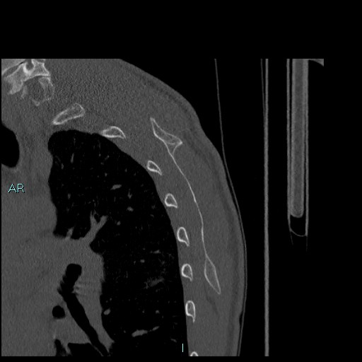 Avascular necrosis after fracture dislocations of the proximal humerus (Radiopaedia 88078-104655 Sagittal bone window 77).jpg