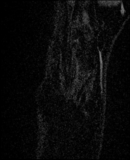 Avascular necrosis of the capitate (Radiopaedia 88317-104948 Coronal T1 vibe 5).jpg