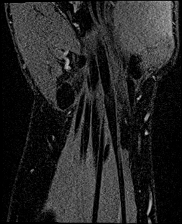 Avascular necrosis of the capitate (Radiopaedia 88317-104948 Coronal T1 vibe 71).jpg