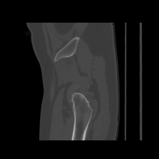 Avascular necrosis of the hip (Radiopaedia 61503-69467 B 54).jpg