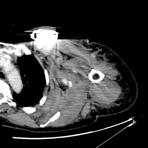 File:Axillary arterial pseudoaneurysm (Radiopaedia 24925-25195 A 14).jpg